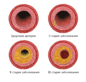 Стадии атеросклероза картинки