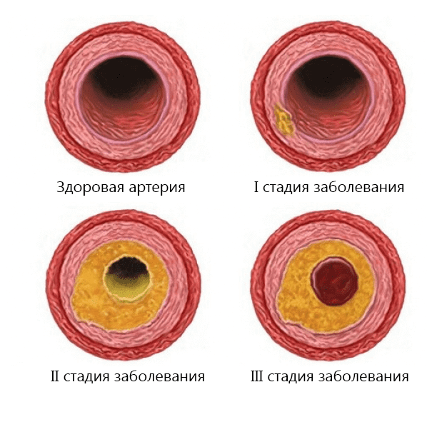 Облитерирующий атеросклероз аорты, подвздошных артерий и артерий нижних конечностей